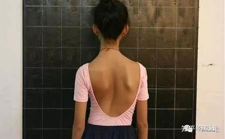 孩子高低肩长短腿警惕脊柱侧弯的可能