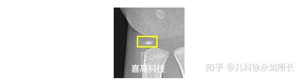 学习中华05标准骨龄鉴定的基础知识 - 知乎