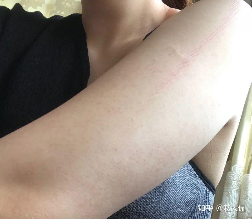 怎样改善脖子上的鸡皮肤(脖子上鸡皮肤怎么消除最有效) 怎样改善脖子上的鸡皮肤(脖子上鸡皮肤怎么消除最有效)