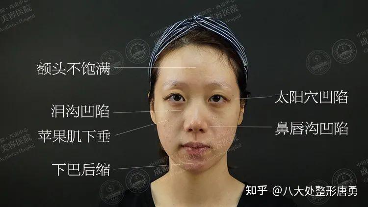 脸垮凹陷逆袭饱满少女脸，面部脂肪填充30天打卡 - 知乎