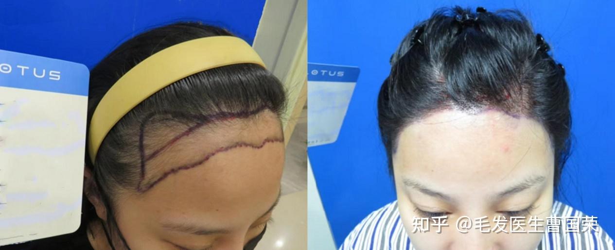 发际线特别高,可以植发吗? - 知乎