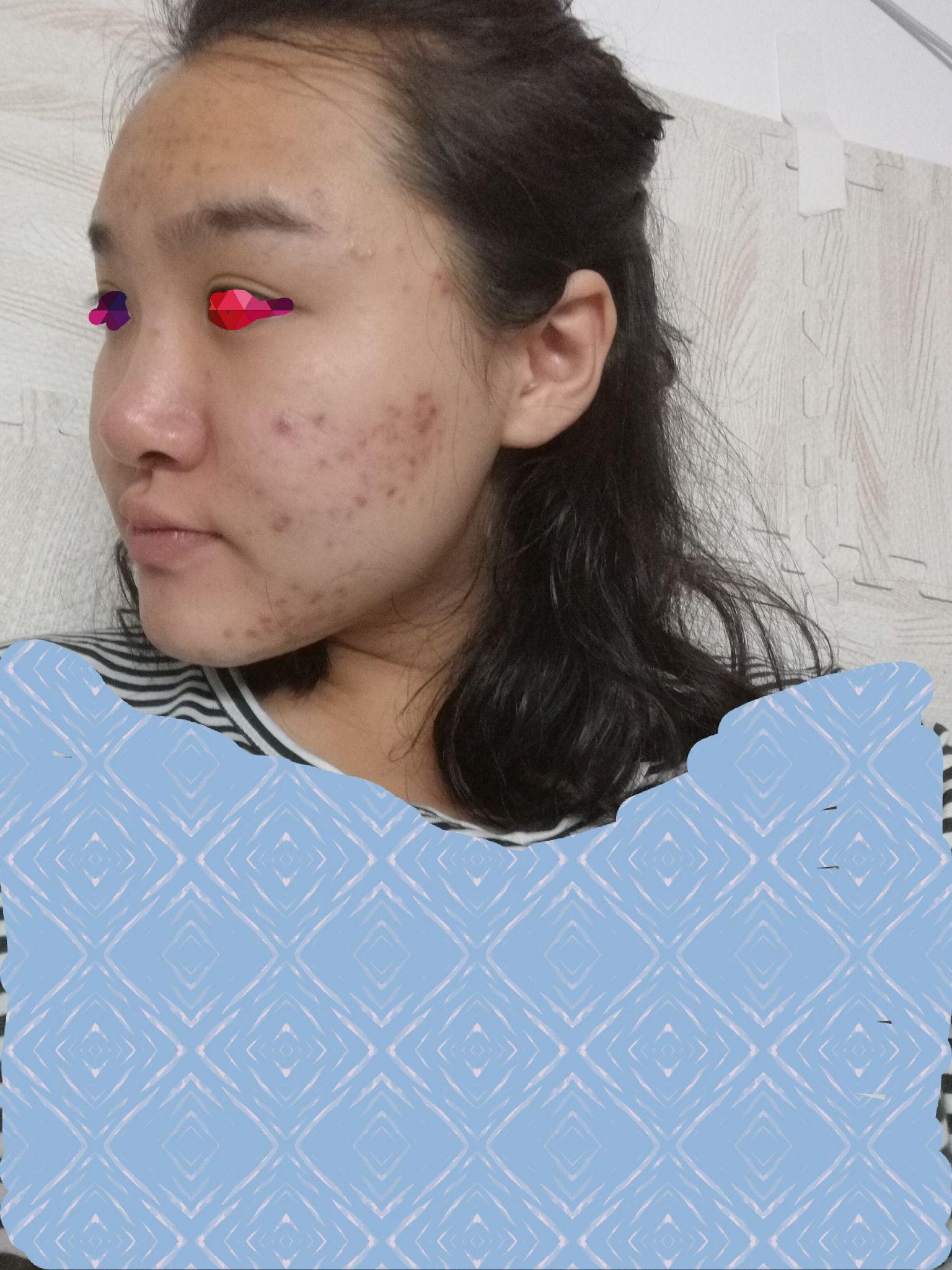 如何快速祛痘变美? - 知乎