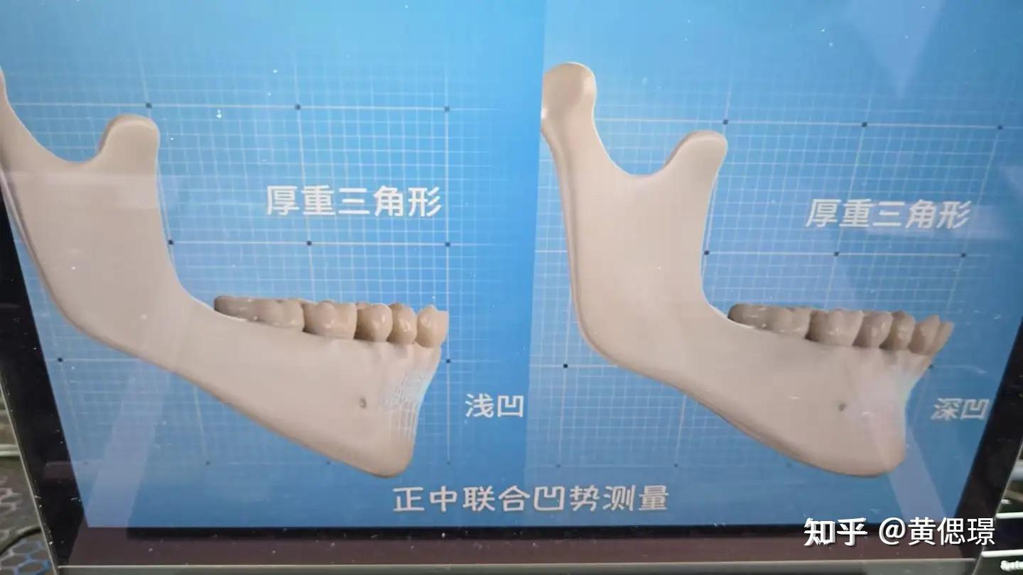 正畸诊断沈刚分类之偏颌 - 知乎