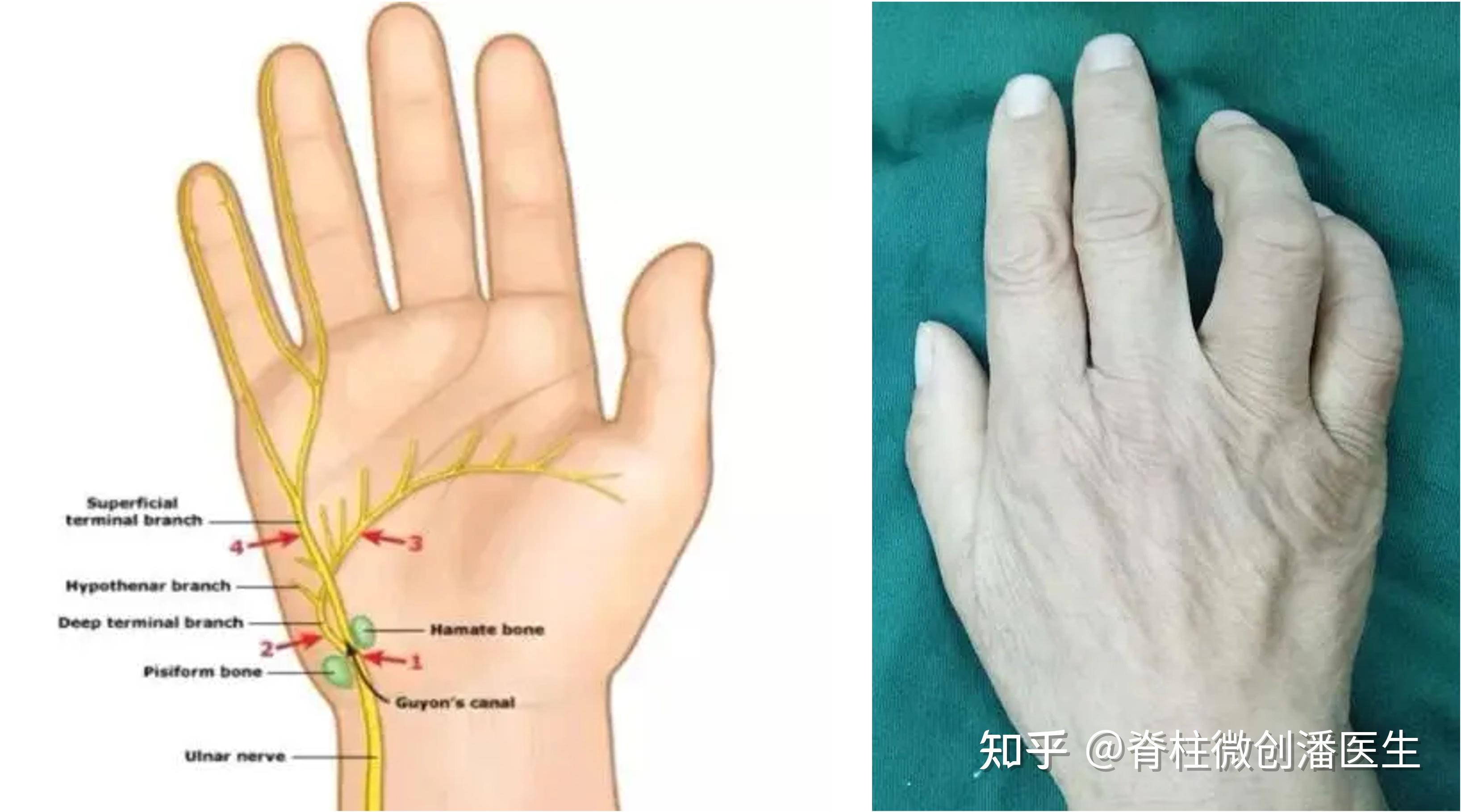 肘管综合征肌电图正常图片