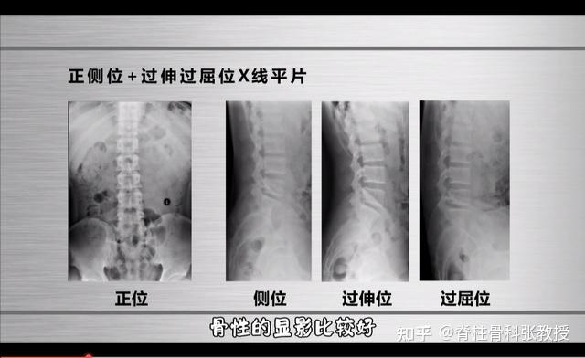 怀疑腰椎间盘突出,应该做哪些检查?