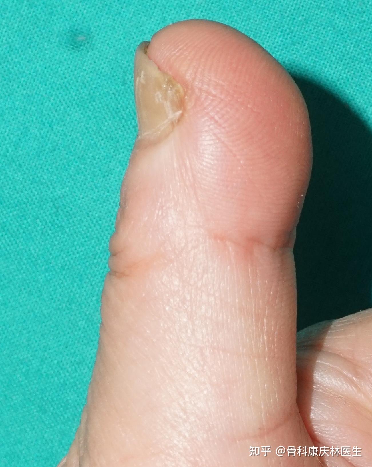 大,最难看的是指甲,宽而短,而且指尖上翘,关节勾屈,活脱脱一副"蛇头"