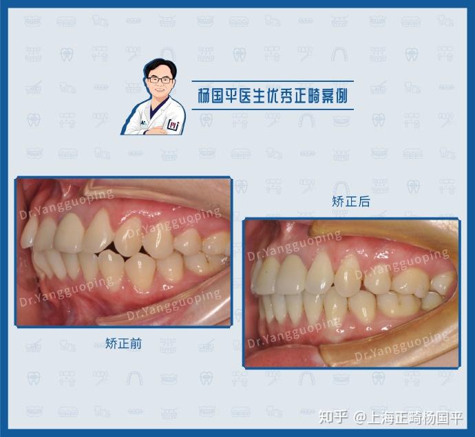 上海牙齒矯正牙列擁擠前突舌側案例分享