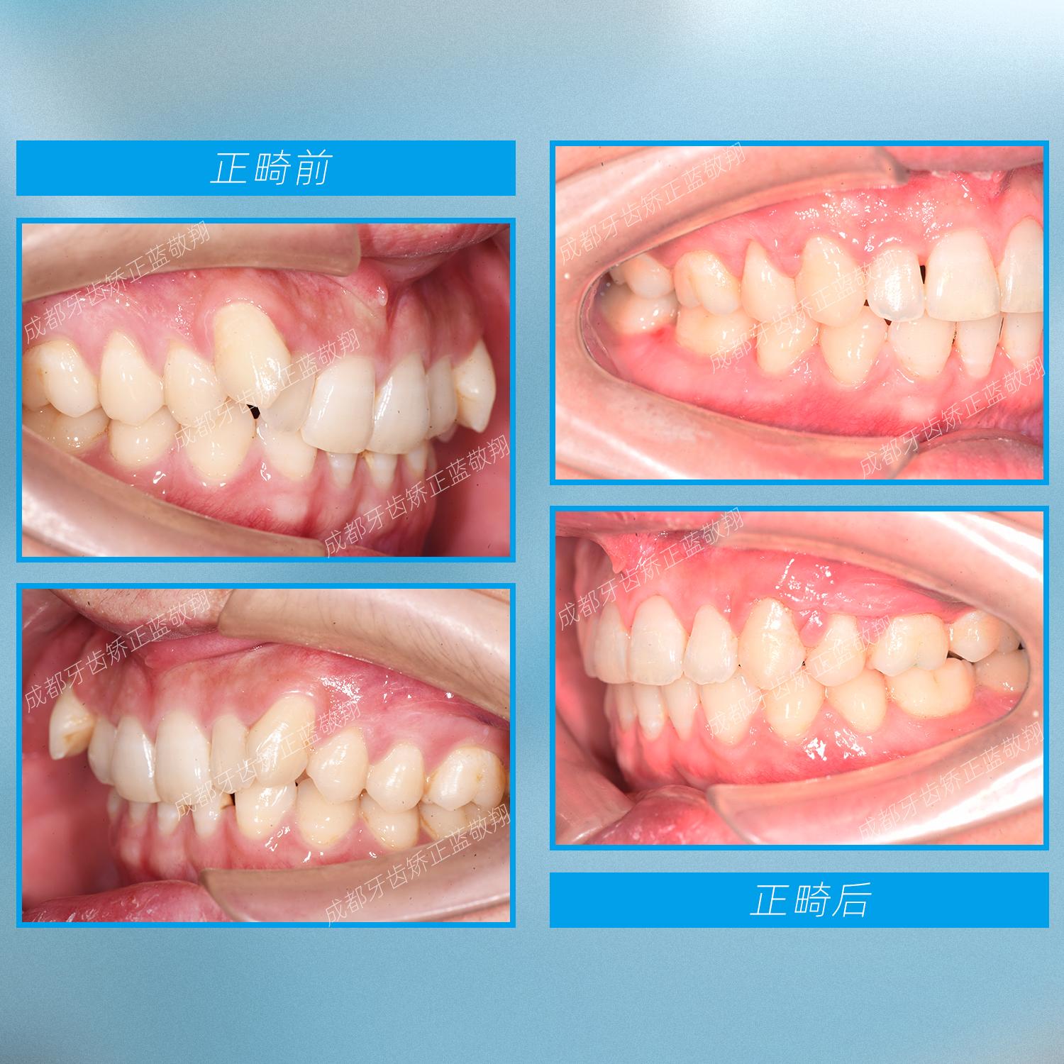 成都整牙内倾型深覆合重度牙列拥挤先天缺失下颌中切牙散在间隙