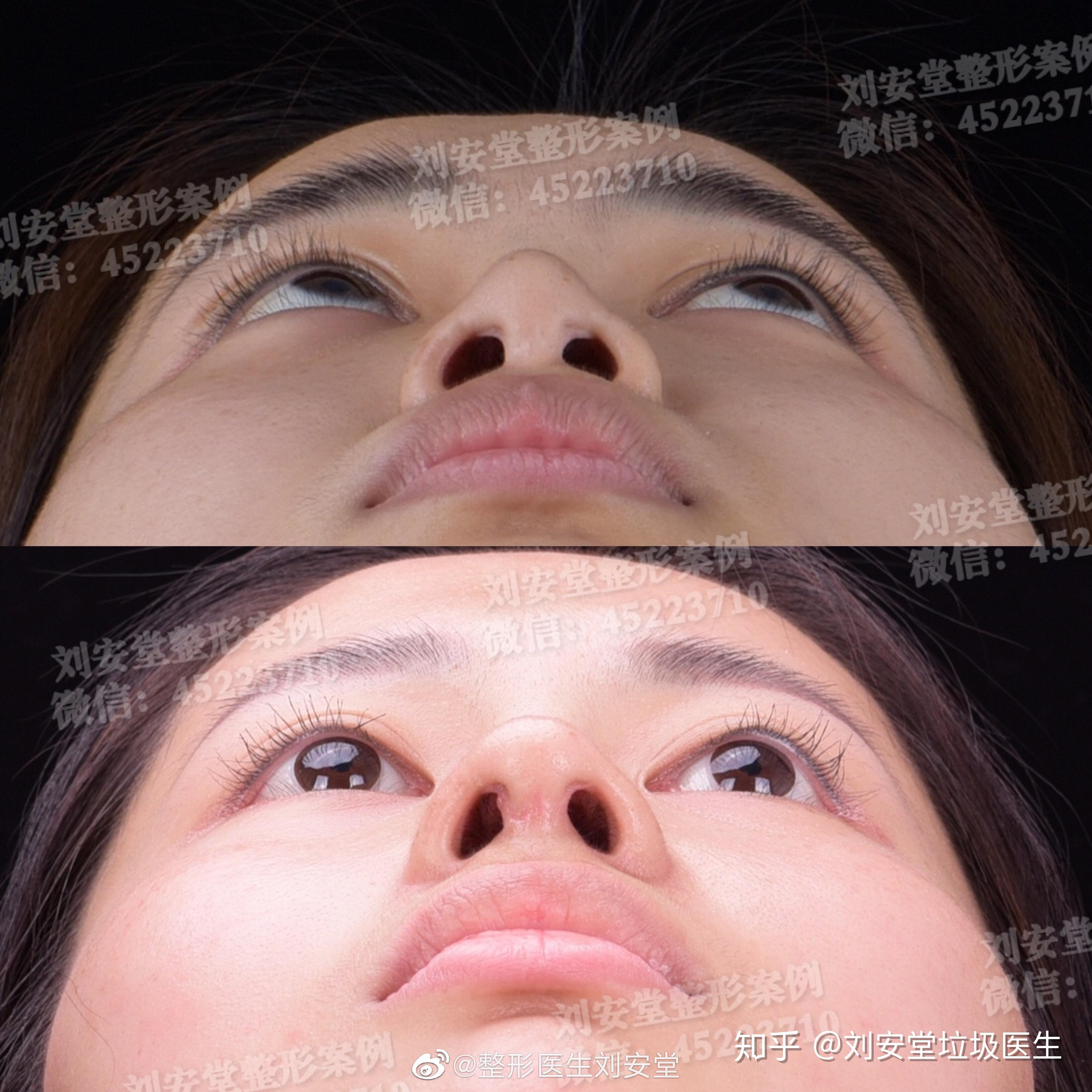 刘安堂给我隆鼻鼻孔大小都不一样