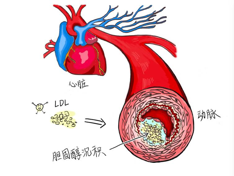 供應心臟自身血液的血管是冠狀動脈,如果這個血管出現問題,心絞痛