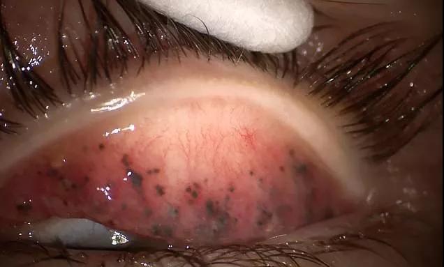 眼皮长结石了解一下!