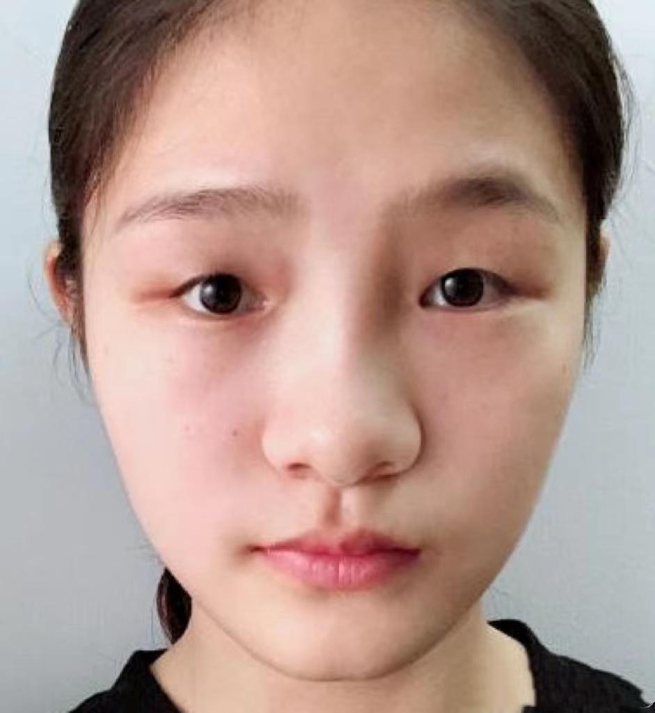 东莞割双眼皮有医院和医生推荐吗是托勿扰