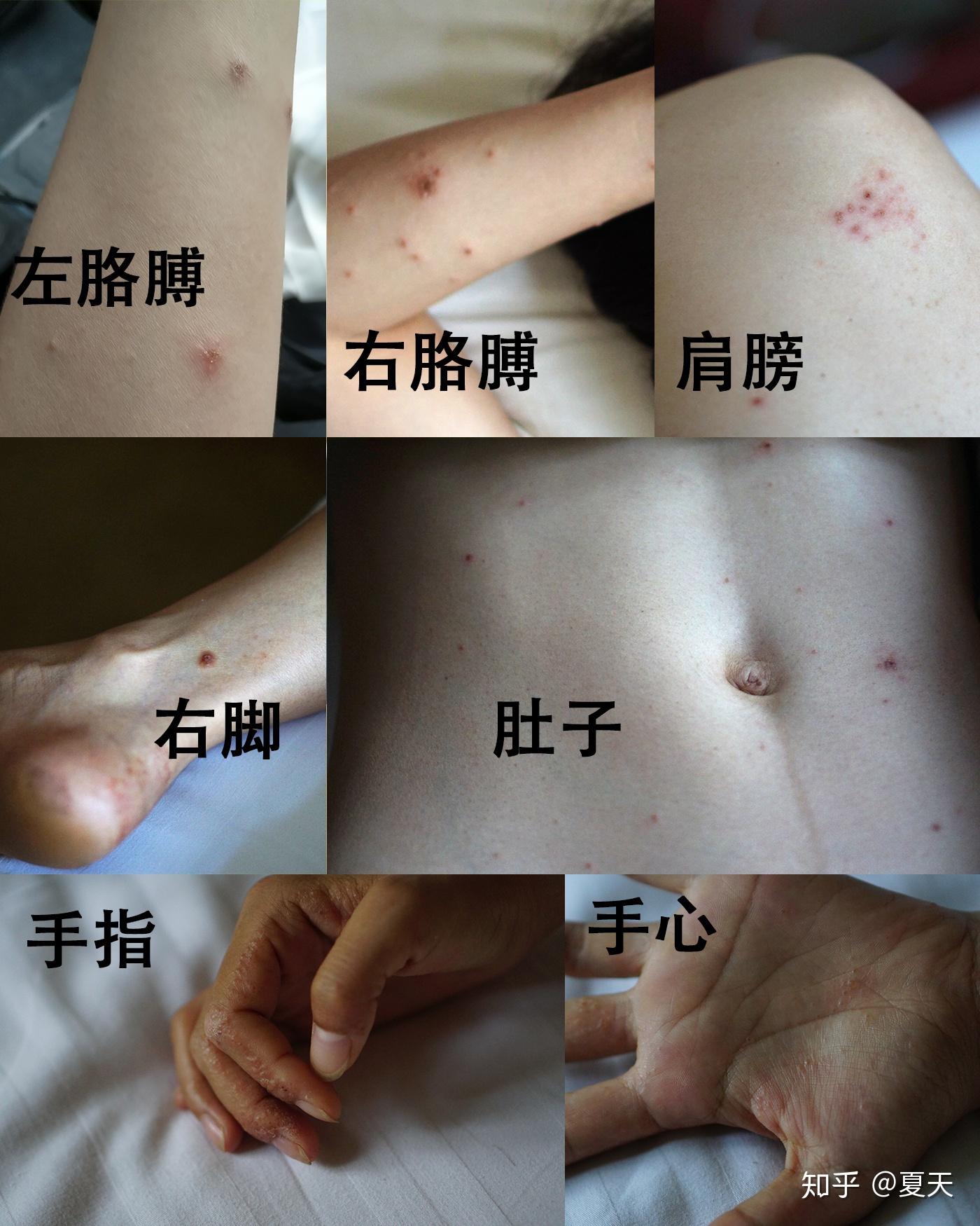 奇痒无比的湿疹治疗历程
