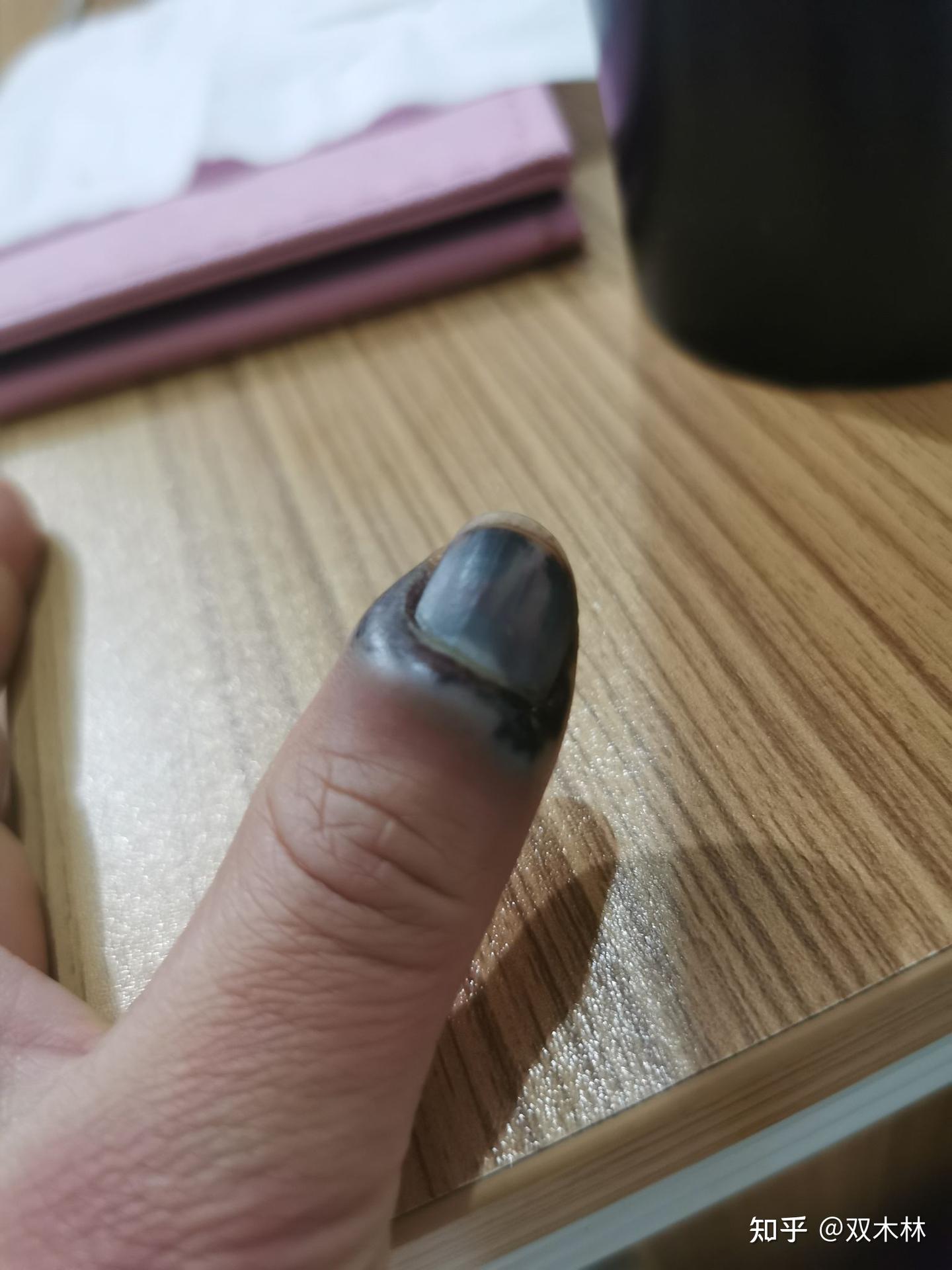 指甲被夹后恢复全过程。 - 知乎