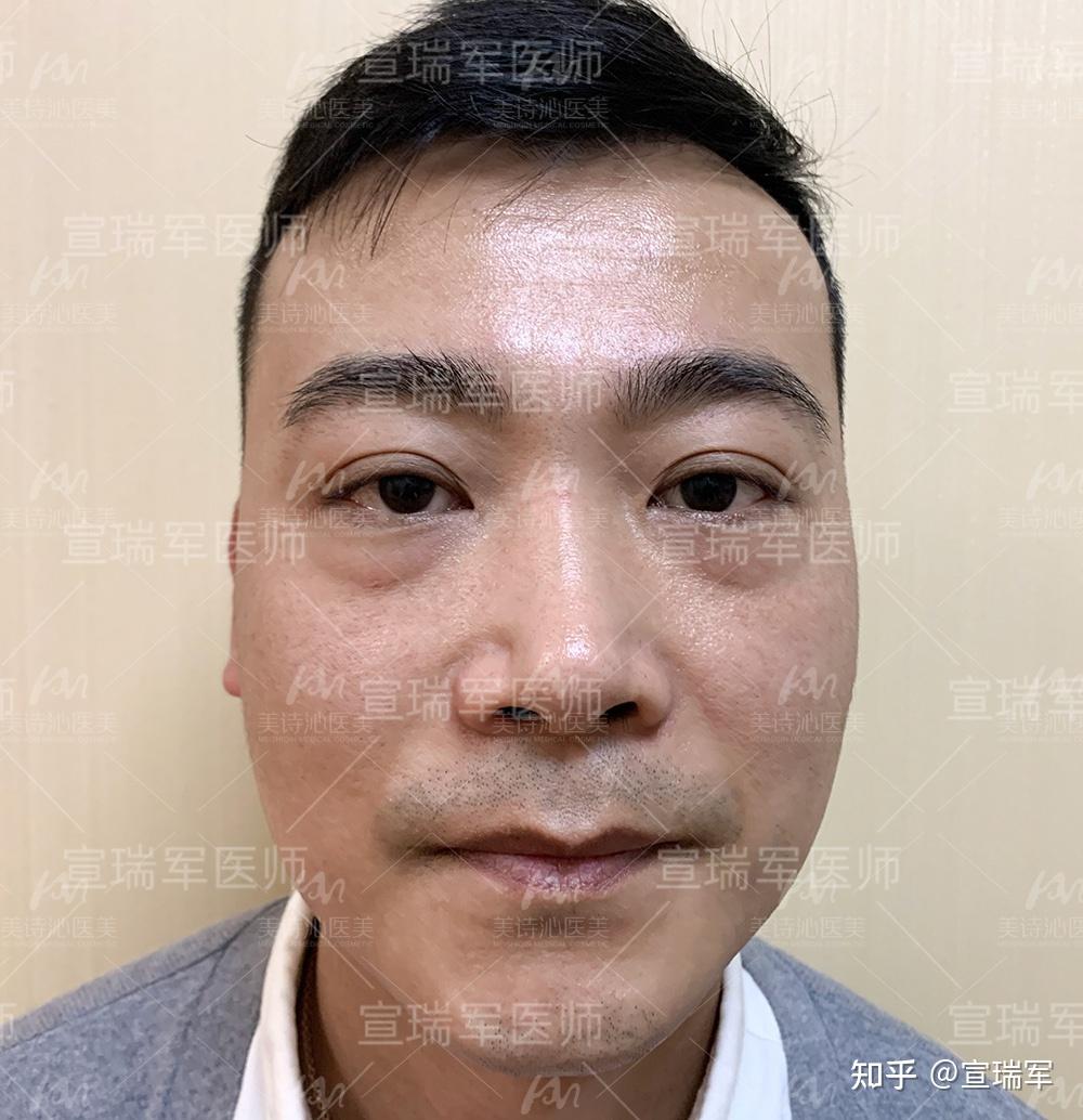 中年男人的眼袋怎么去39岁用这个方法不开刀不留痕解决了
