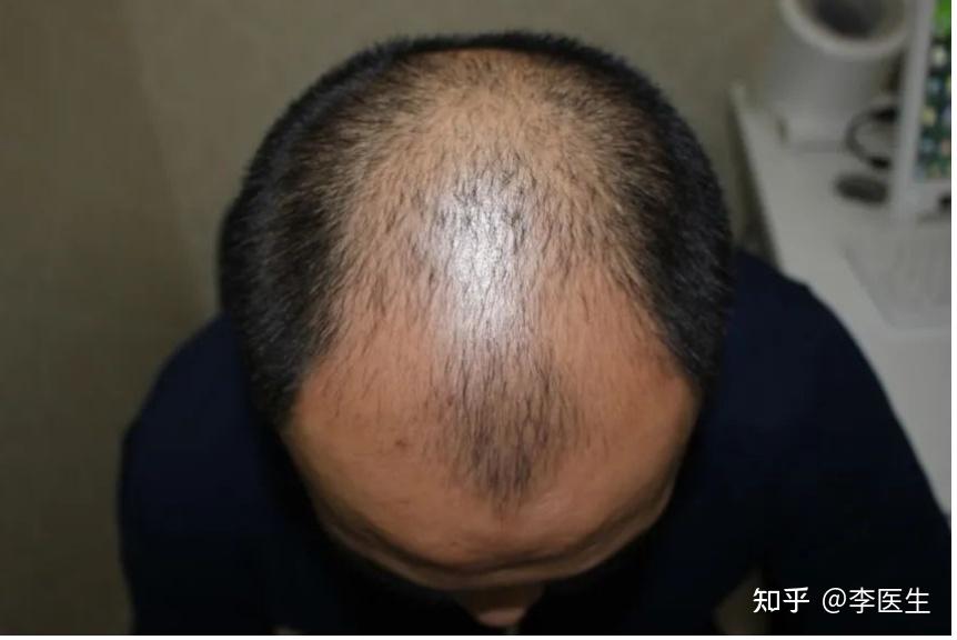 植发医院排名_深圳植发医院一般多少钱新生植发_植发医院选择攻略