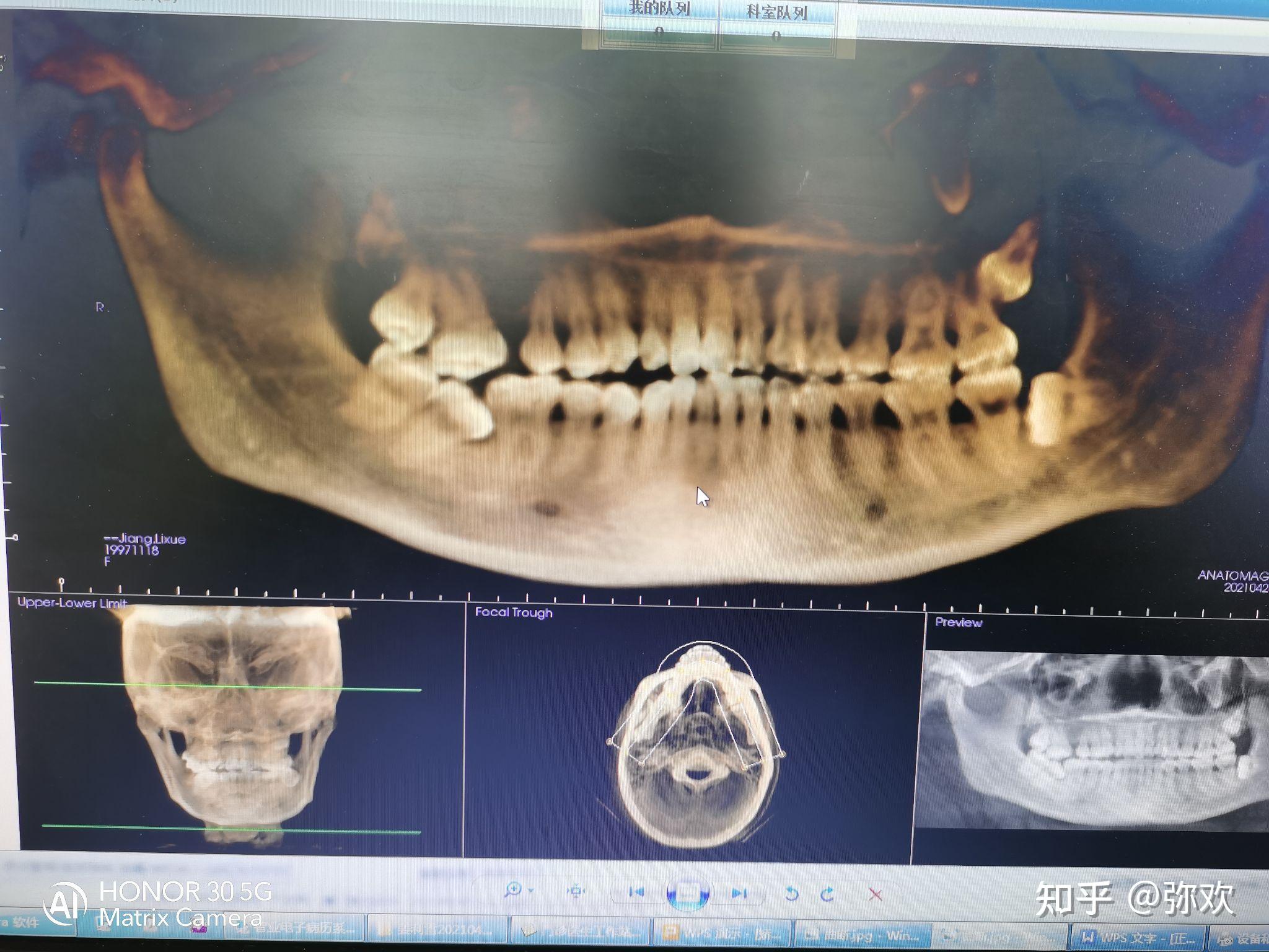 右上缺6號牙智齒正畸能否成功還嘴凸