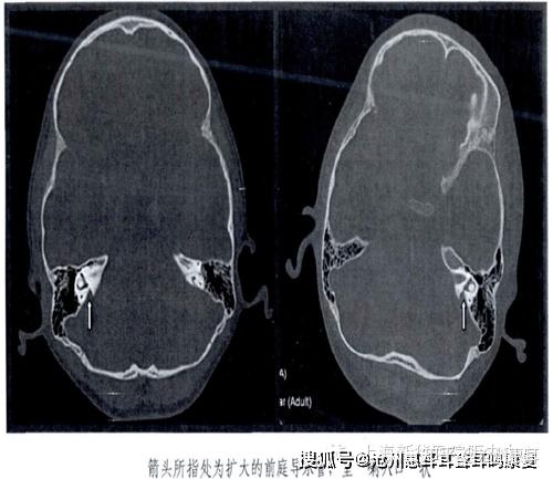 沧州惠耳教你读懂CT片——大前庭导水管综合征的CT影像学诊断 - 知乎