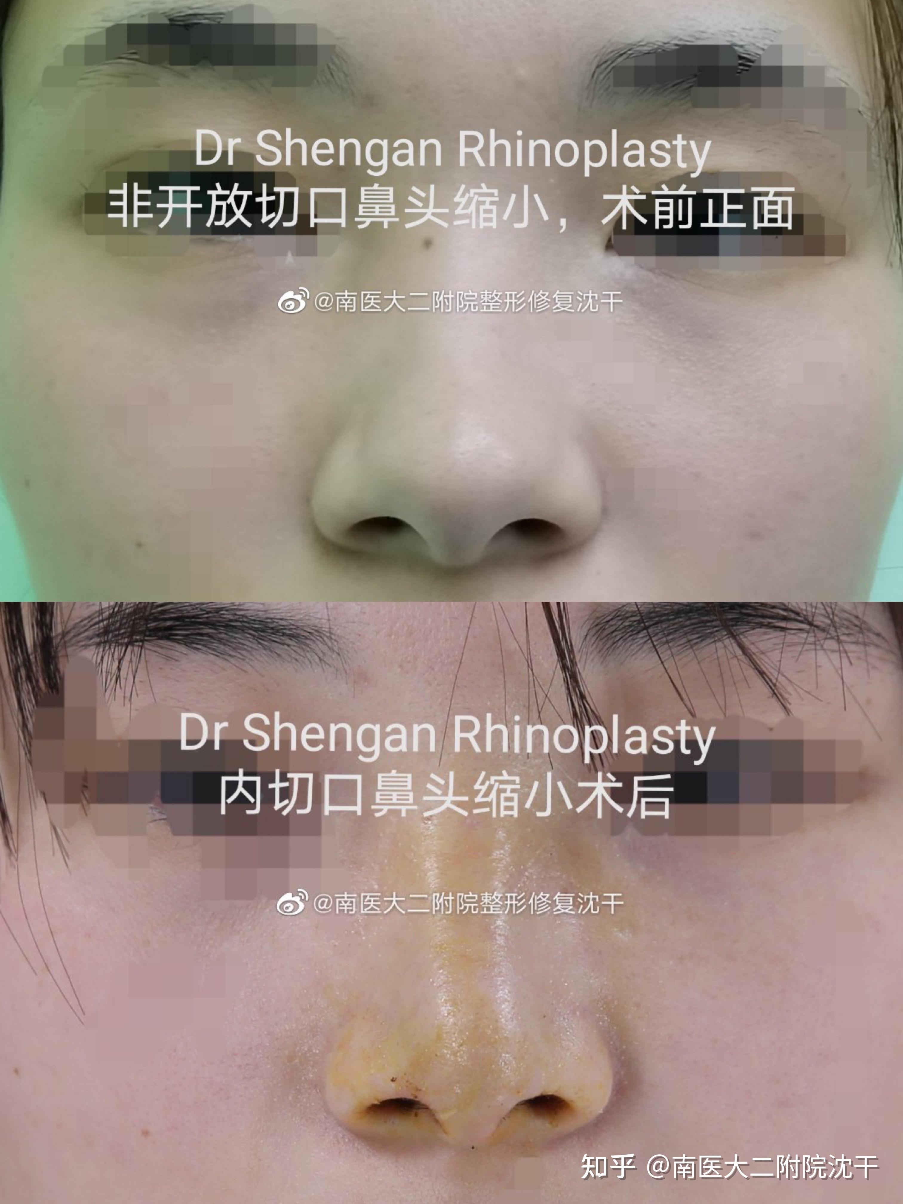 鼻翼缩小# #南京隆鼻#这样鼻小柱不留疤痕,手术后鼻夹板塑形.