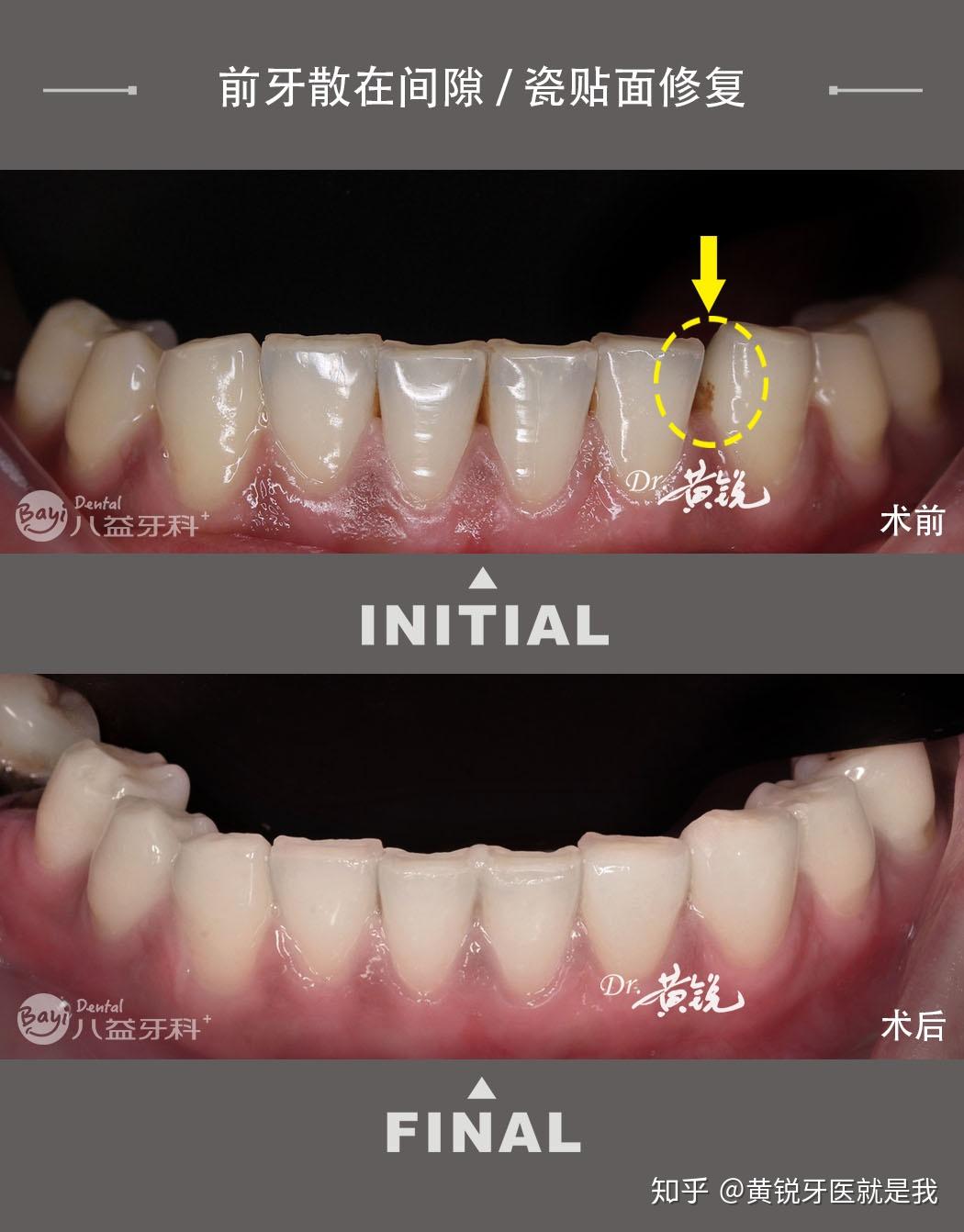 前牙散在間隙瓷貼面修復