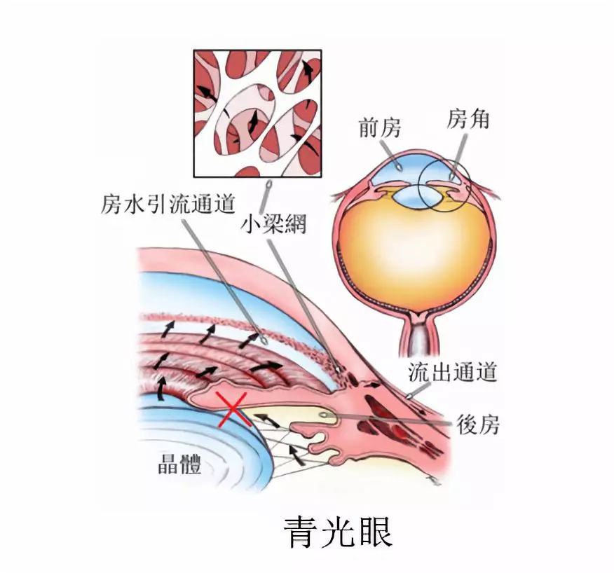 得了青光眼就等于被判死刑