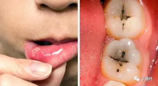 结果可能是牙齿和口腔的问题:牙釉质过敏,蛀牙,蛀牙和粘膜溃疡.