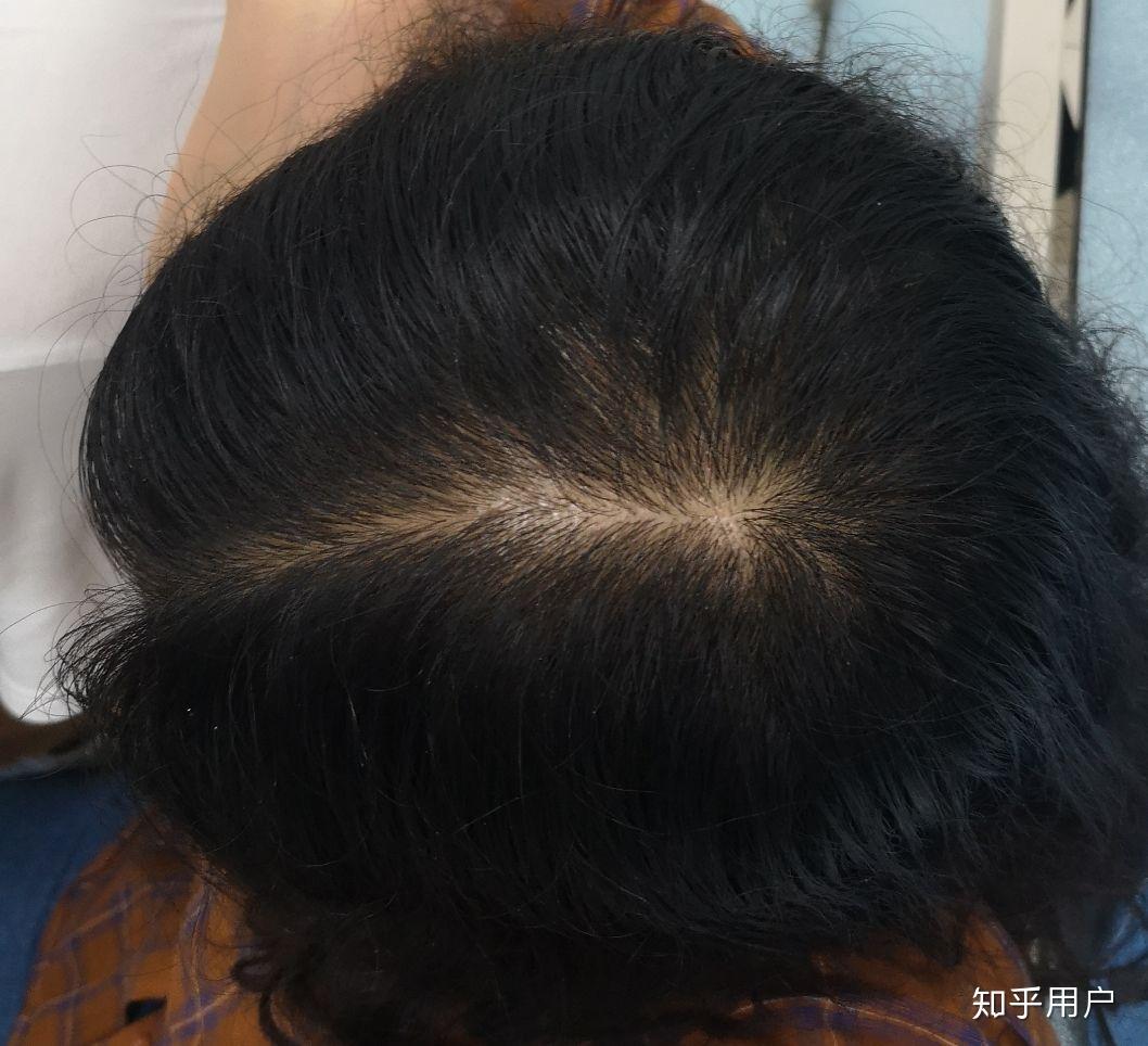 女生头顶头发少是什么体验 ?