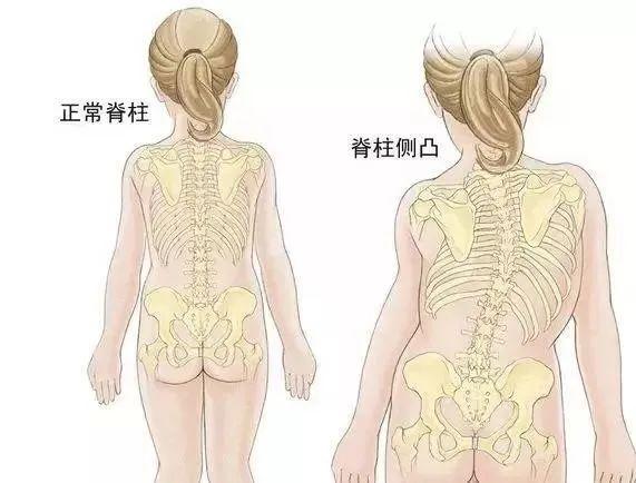 脊柱侧弯如何正确拍摄x光片