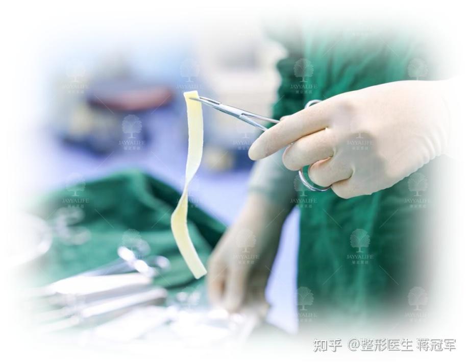 3D生物束带紧缩术能维持几年 - 知乎
