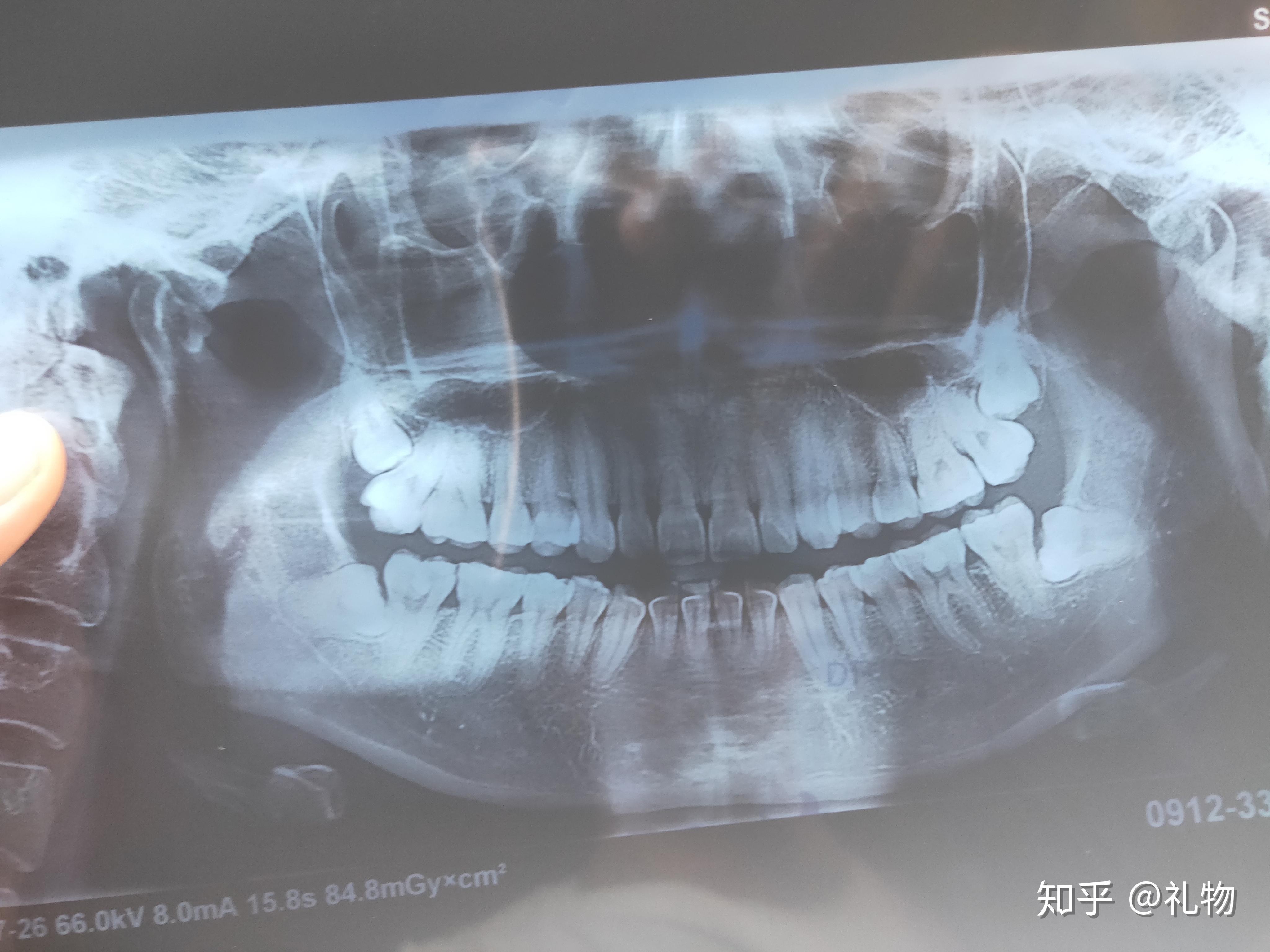分享拔上下两颗智齿的感受