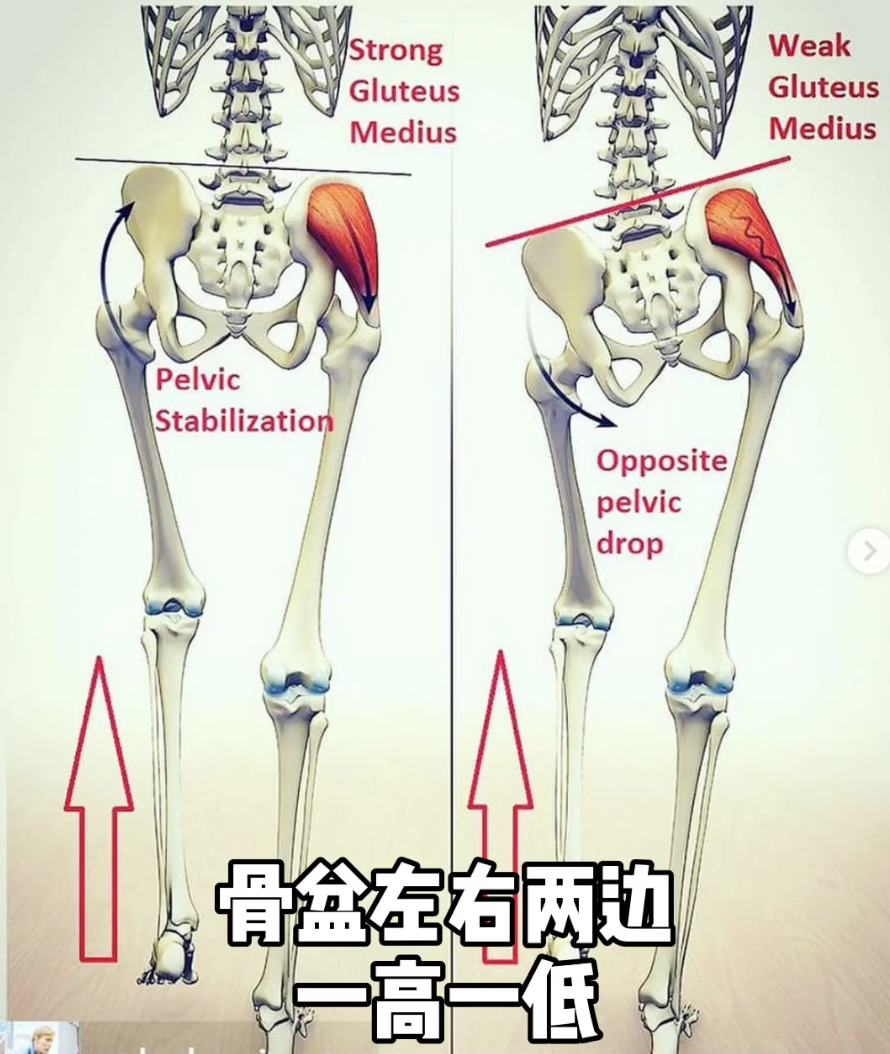 骨盆不正很影響腰痛腰骶疼痛