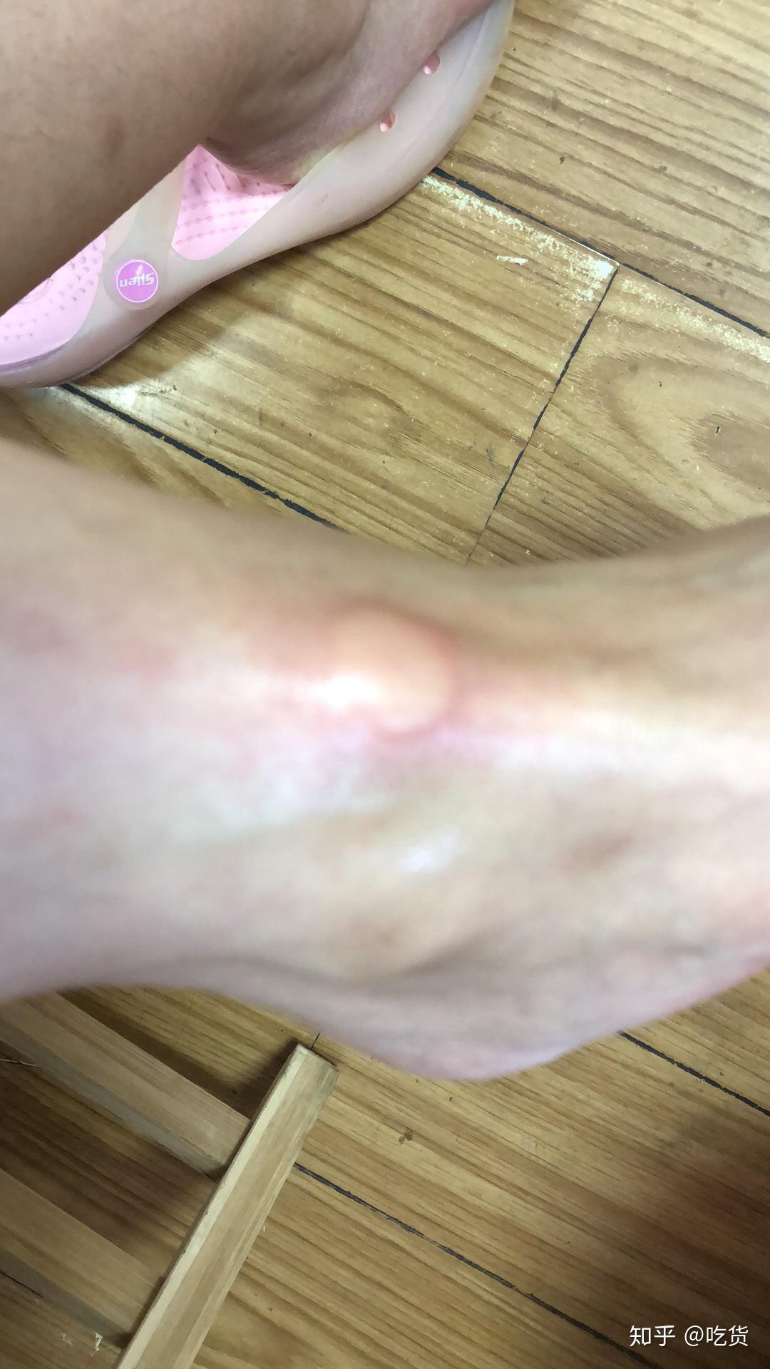 蚊子咬后肿大包之前没有这个状况什么原因