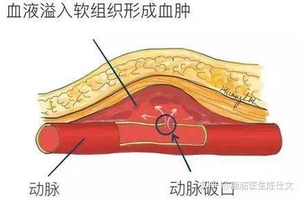 1,血腫導致的正常硬塊為什麼抽脂後會有硬塊?