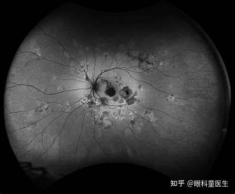 后葡萄膜炎13匍行性脉络膜炎