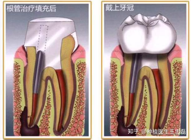 根管治疗后牙冠材质怎么选医生vs患者各执一词