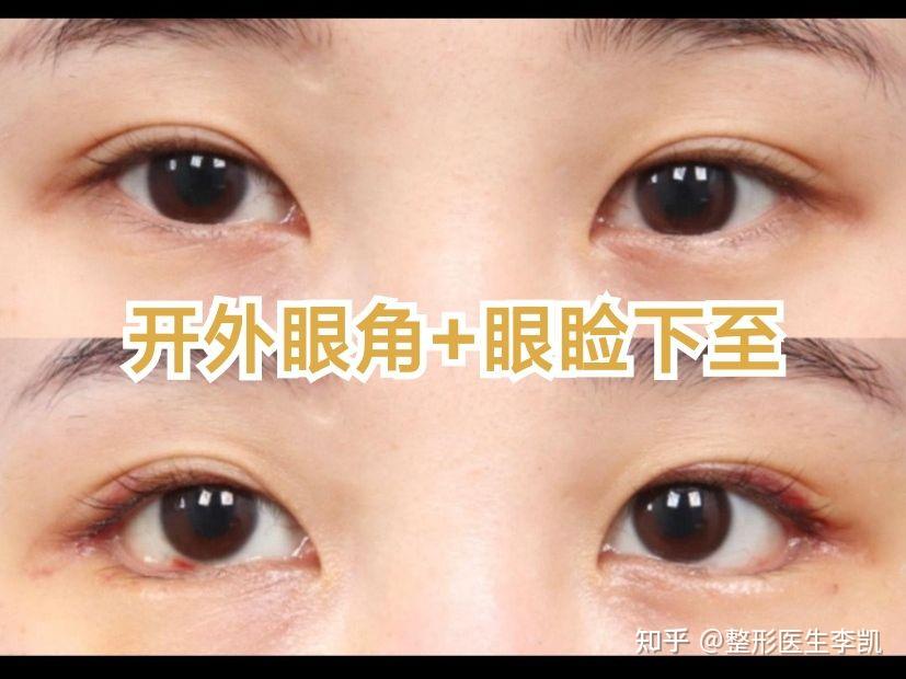 开外眼角 眼睑下至,"吊梢眼"秒变无辜小鹿眼 - 知乎