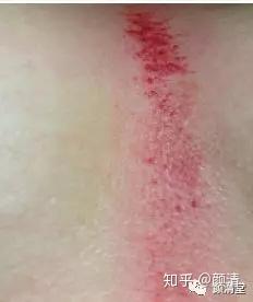为什么要刮痧？从痧相来看你的身体健康！ - 知乎