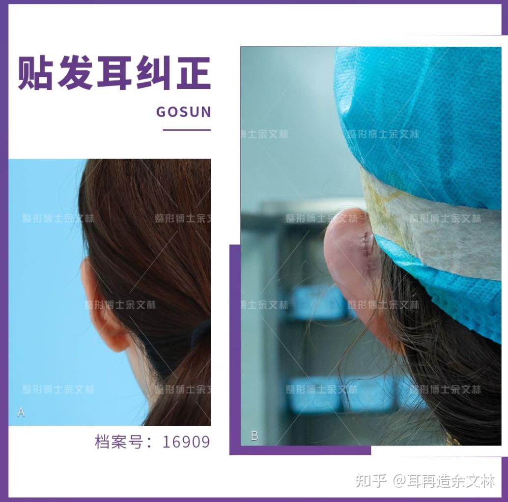 贴发耳矫正是不是每个人都能做出非常好的效果