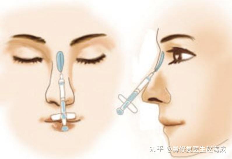 “塌鼻子”不秀气怎么改善?你可以选择这几个方式! - 知乎