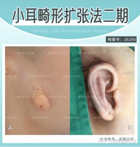 耳再造扩张法为什么“打水”三个月？而不是几天？余文林解答！