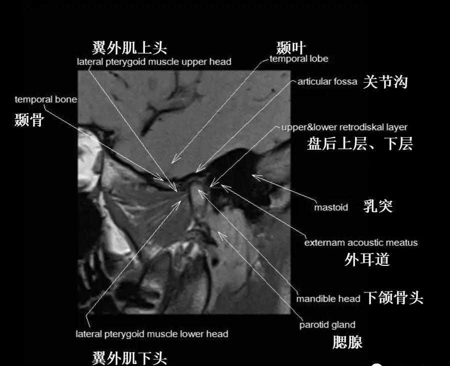 颞颌关节解剖及高清影像 - 知乎