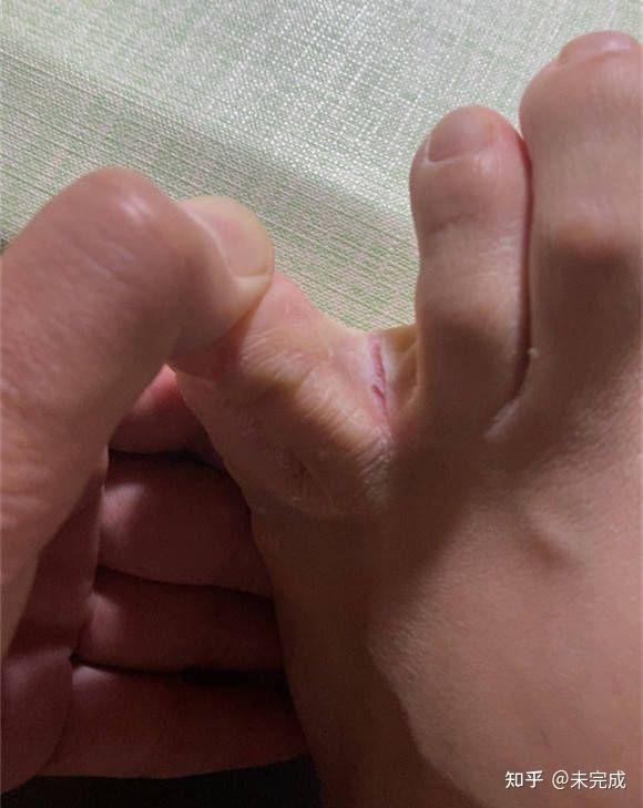 脚气怎么治具体方法推荐