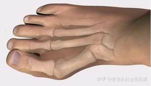 纪柳:拇指外翻手术,作为家中顶梁柱的他,这样说…… - 知乎