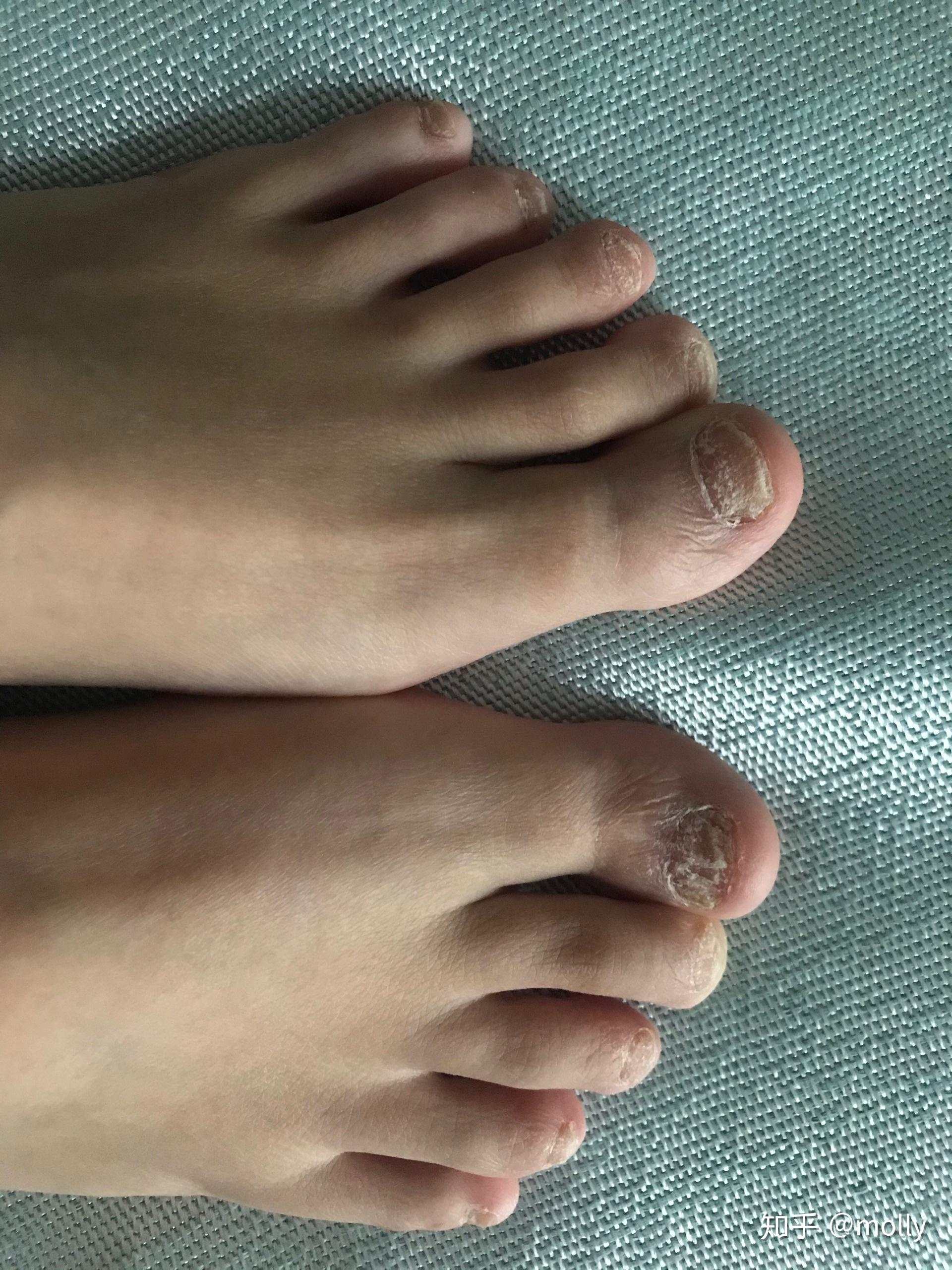 指甲银屑病的第十年