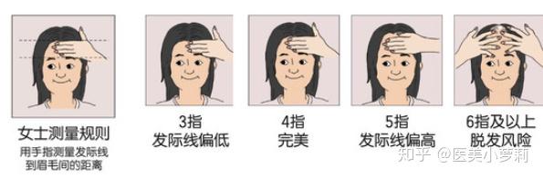 如何知道你的发际线是否在正常范围? - 知乎