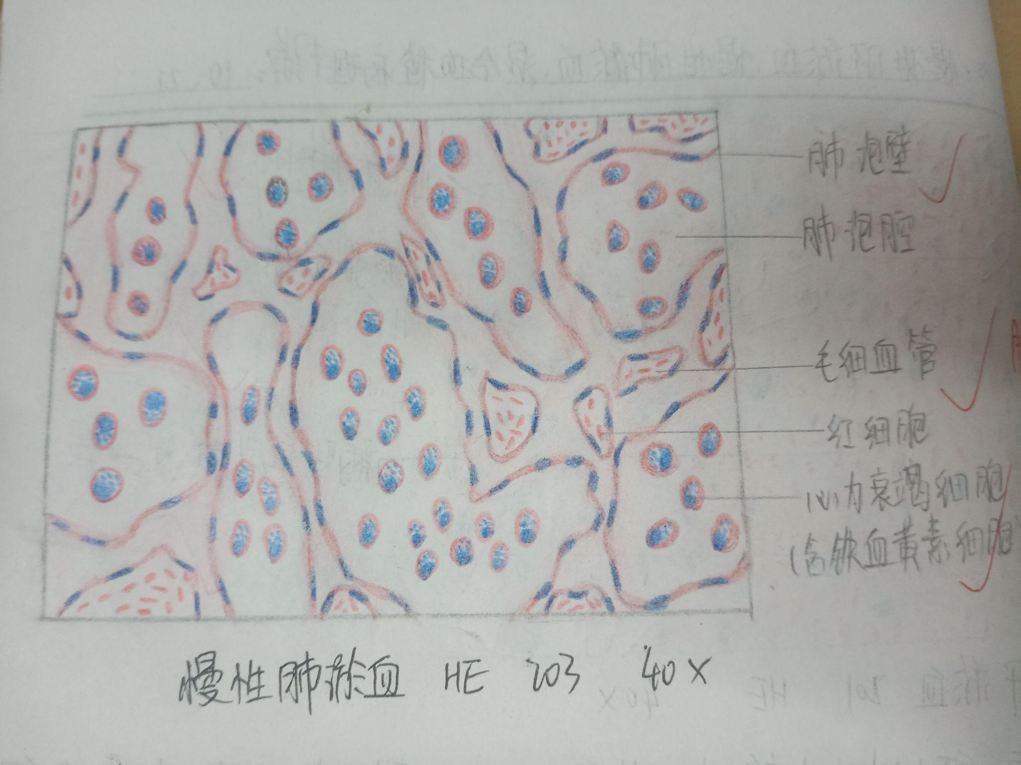 肺淤血切片图手绘图图片