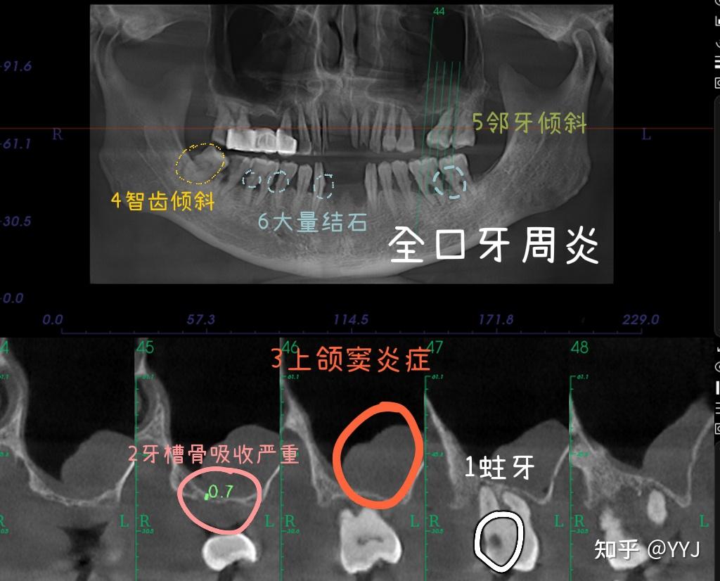 口腔拍片是坑吗