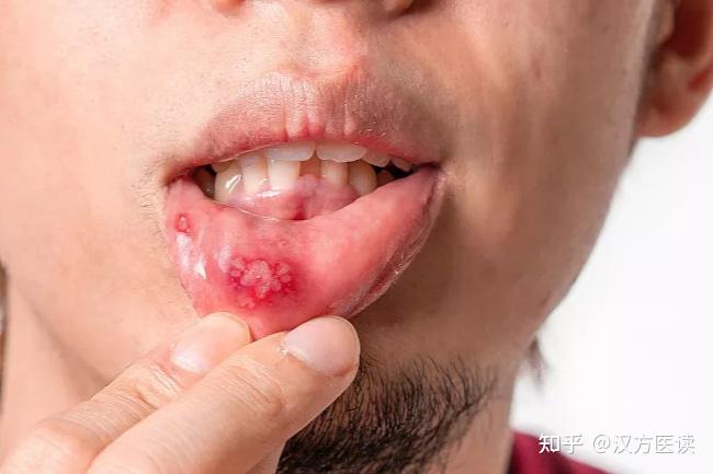 舌底口腔溃疡图片