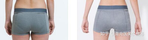 臀部溶脂手术有效果吗 怎么样 知乎