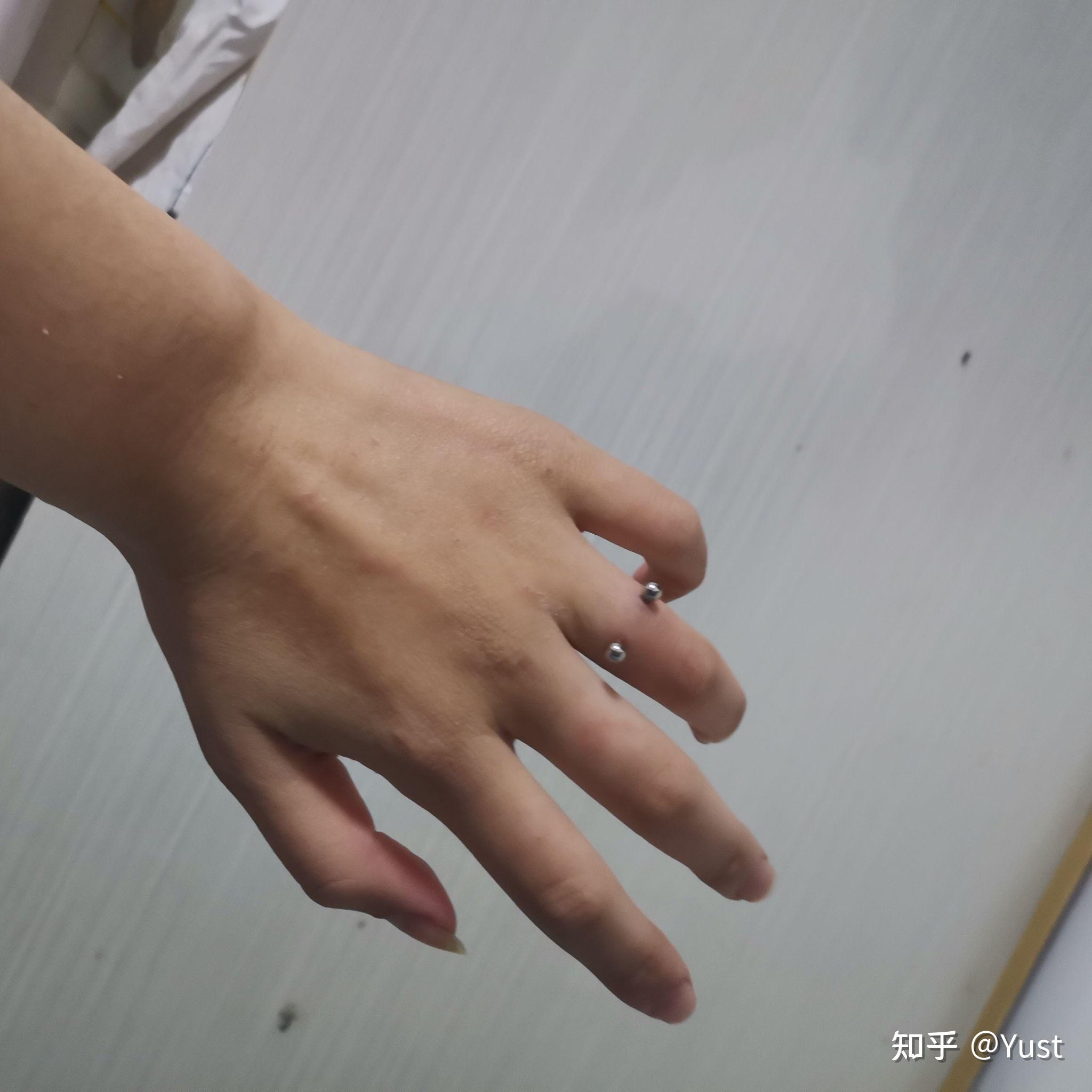 手指钉orward helix恢复记录 - 知乎